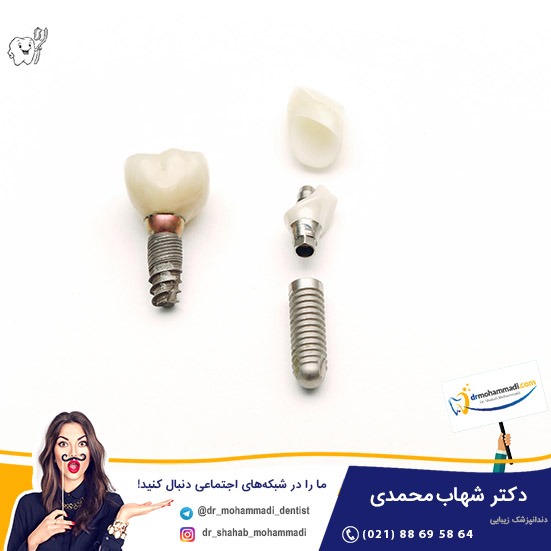 طول عمر ایمپلنت دندان چقدر است؟ ایا ایمپلنت مادام العمر است - کلینیک دندانپزشکی دکتر شهاب محمدی